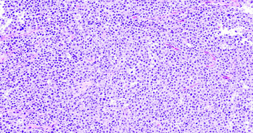 Diffuse large B-cell lymphoma