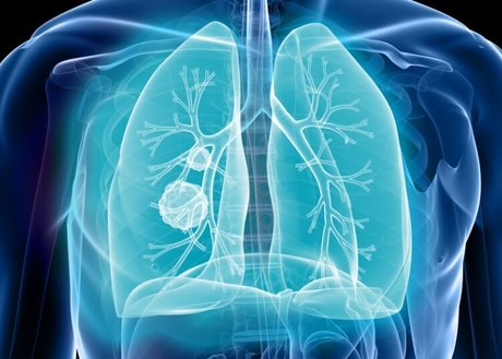 Early-Stage Non-small Cell Lung Cancer